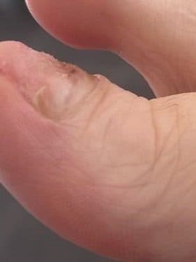Утолщённая ногтевая пластина — после лечения